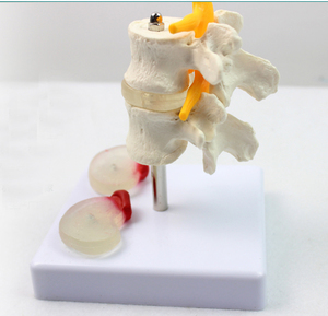 “2节腰椎附2个病变椎间盘模型