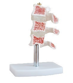 “骨质疏松模型 脊椎典型病变模型