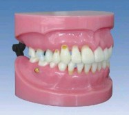 “牙周病演示模型